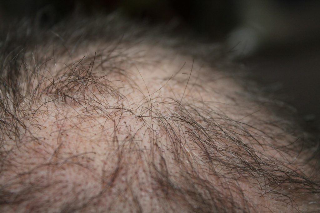 Zink hilft bei Haarausfall
